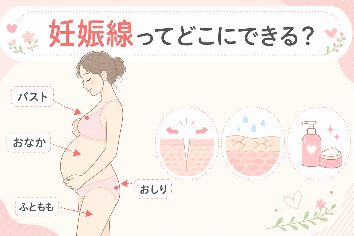 妊娠線ができる場所の図解
